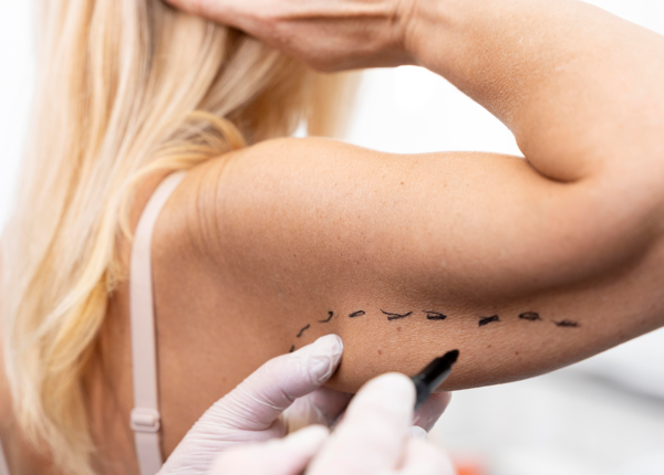 Brachioplasty (Arm Lift)