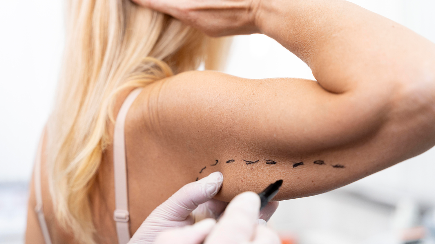 Brachioplasty (Arm Lift)