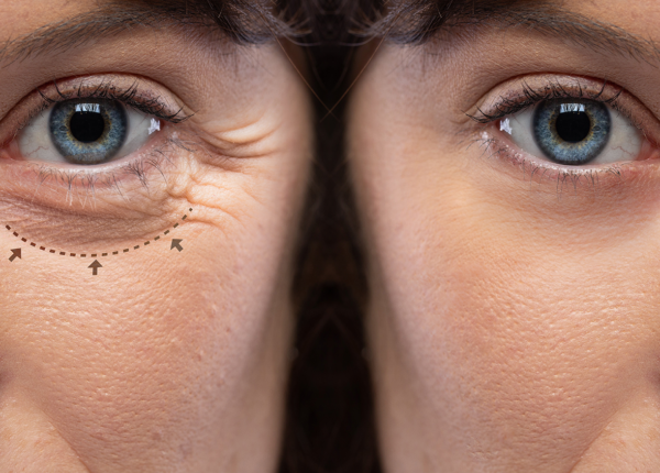 Eyelid Surgery (Blepharosplasty)