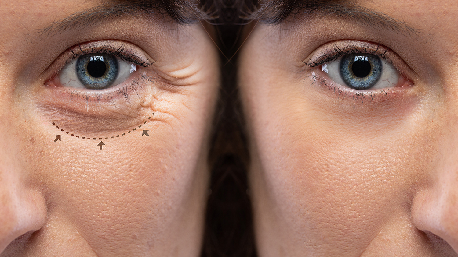 Eyelid Surgery (Blepharosplasty)