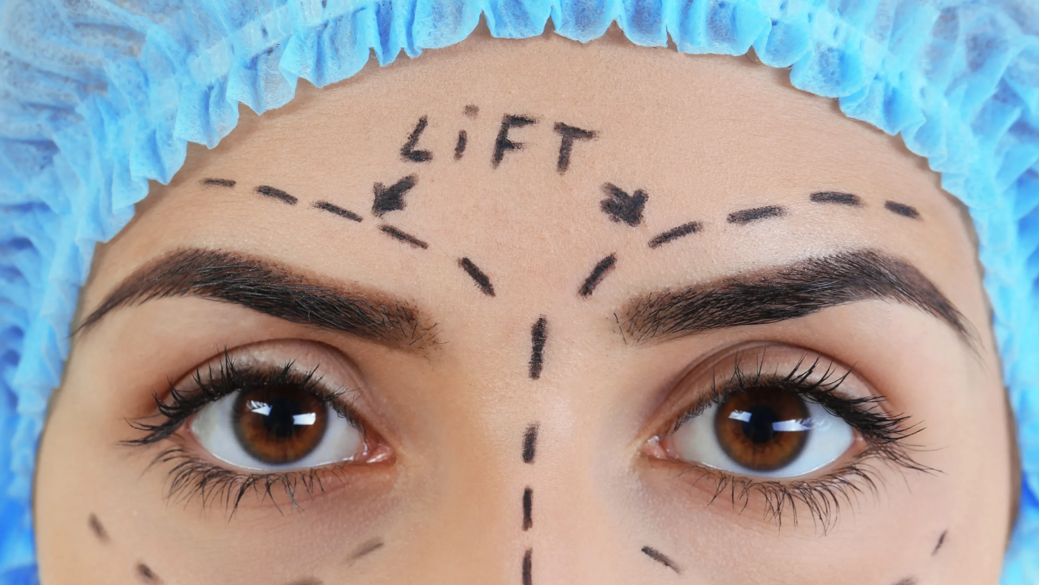 Endoscopic brow lift: The modern technique for forehead tightening with Dr. Mutaz Al Shakhanbeh