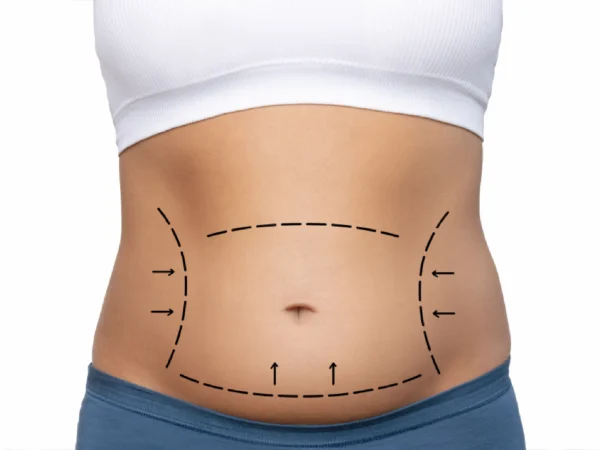 Tummy Tuck: The Effective Solution for Eliminating Sagging and Restoring a Firm Abdomen with Dr. Motaz Al Shakhanbeh