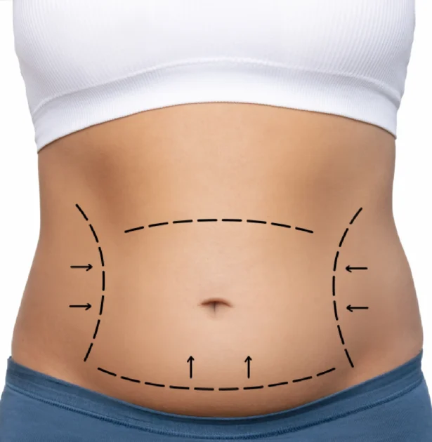Tummy Tuck: The Effective Solution for Eliminating Sagging and Restoring a Firm Abdomen with Dr. Motaz Al Shakhanbeh