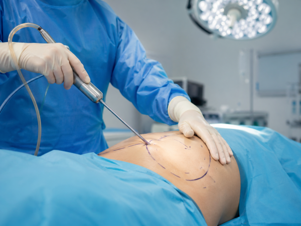 عملية شفط الدهون في الأردن – الحل الأمثل لنحت الجسم مع د. معتز الشخانبة