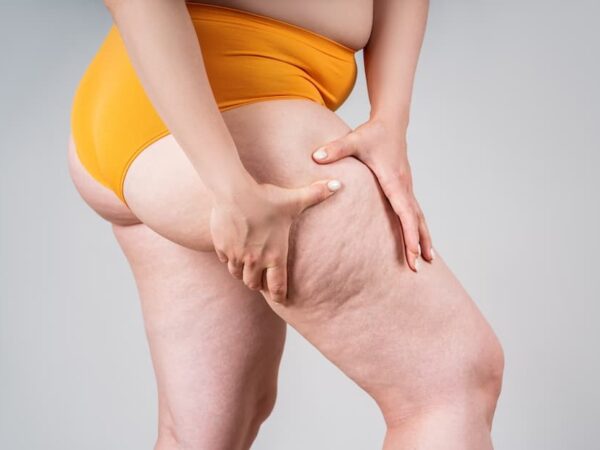 علاج الوذمة الشحمية (Lipedema): الأسباب والأعراض وأحدث خيارات العلاج في الأردن