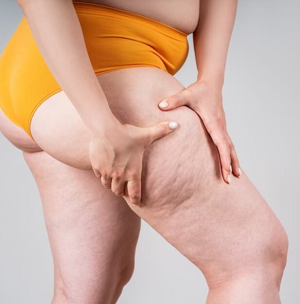 علاج الوذمة الشحمية (Lipedema): الأسباب والأعراض وأحدث خيارات العلاج في الأردن